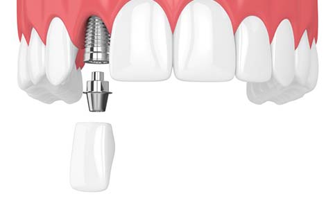 dental implant with a crown being placed in the upper arch
