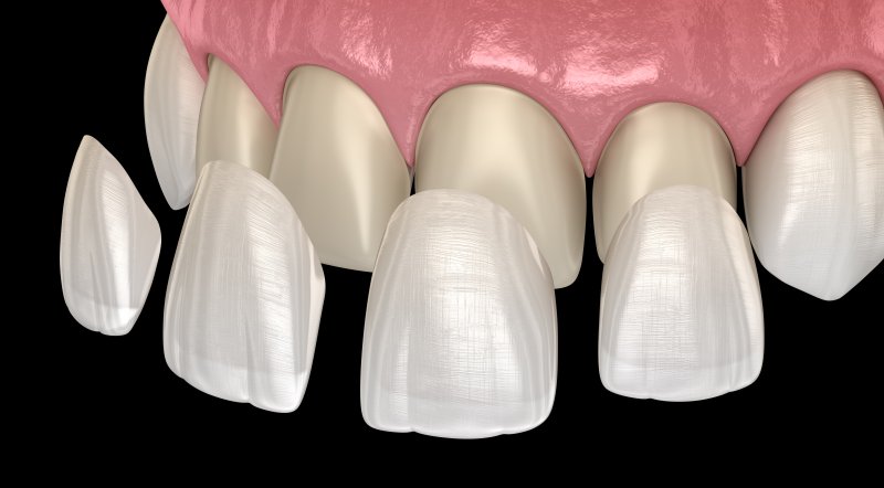 model of several veneers being placed over a patient’s front teeth