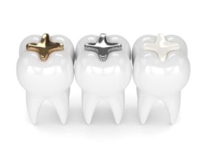 Model of teeth with metal amalgam fillings.