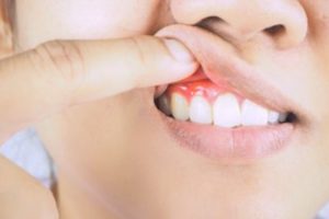 Person inspecting their swollen and red gums. 