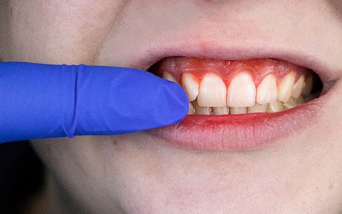 Close-up of red, inflamed gums suffering from periodontal disease