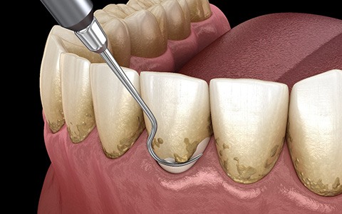 Illustration of tool being used to remove plaque and tartar from teeth