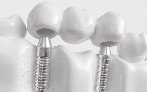 A dental bridge in Corte Madera, CA supported by dental implants