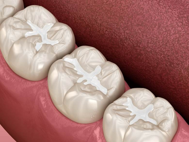 a closeup of tooth-colored fillings in Corte Madera, CA