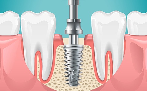 a single implant replacing a lost tooth