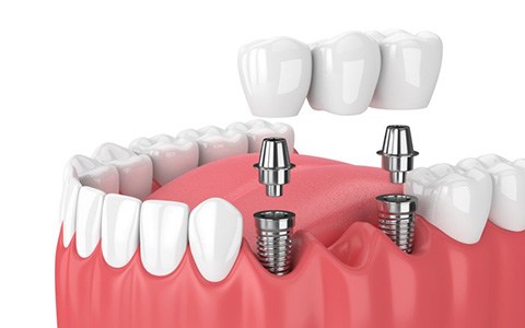 an image of implants securing a dental bridge