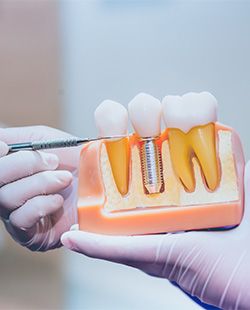 Dentist pointing to a dental implant